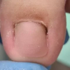 Wilde Pedique (anti-mycotische gel)